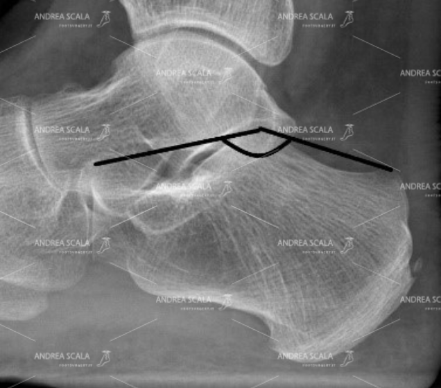 FIGURA 1 Il calcagno sopporta tutto il peso del corpo. L’articolazione tra calcagno e astragalo è la prima che tocca il suolo quando si cammina. Ecco perché va accuratamente ricostruita.