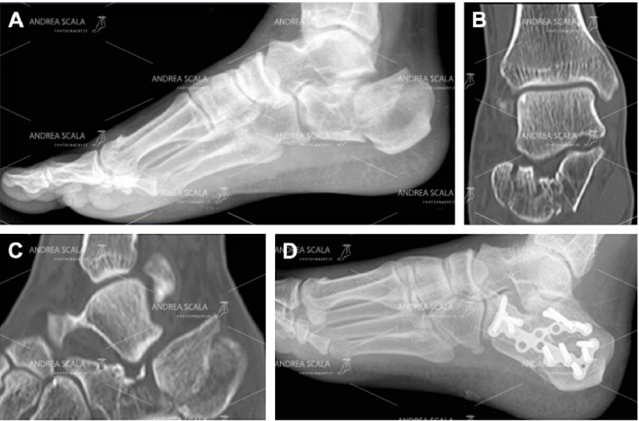 La frattura di calcagno si vede nella RXgrafia, ma la TAC mostra ancora meglio come si è rotta l’articolazione e come sono spostati i frammenti. L’operazione deve ricomporre l’articolazione ed i frammenti della frattura. Si vede che i frammenti sono stati ricomposti uno a uno come un puzzle e sonno stati stabilizzati con placca e viti. Solo così il paziente può iniziare a camminare su di un piede ricostruito. Non bisogna fare pasticci con il “percutaneo”.