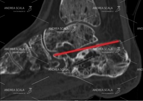 La TAC eseguita dopo l’intervento con i fili di acciaio fa vedere molto bene che il calcagno è rimasto schiacciato. L’angolo di Bohler non è stato ricostruito. L’articolazione è rimasta infossata come il giorno dell’incidente.