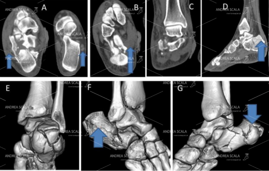 La Radiografia non è sufficiente per capire la gravità della frattura del calcagno. E’ necessario fare la TAC. Dopo la frattura il calcagno è schiacciato, l’angolo di Bohler è appiattito, l’articolazione è spezzata, si vedono bene i frammenti della frattura.