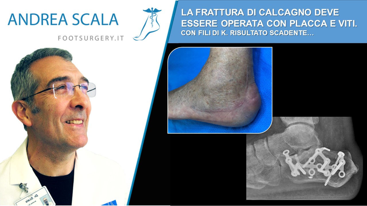 LA FRATTURA DI CALCAGNO DEVE ESSERE OPERATA CON PLACCA E VITI. CON I