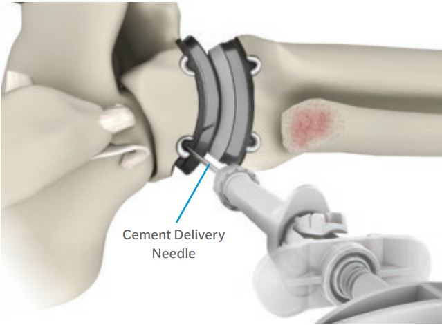 La figura mostra la protesi Zimmer impiantata dopo aver scavato due superfici curve nell’astragalo e nella tibia.