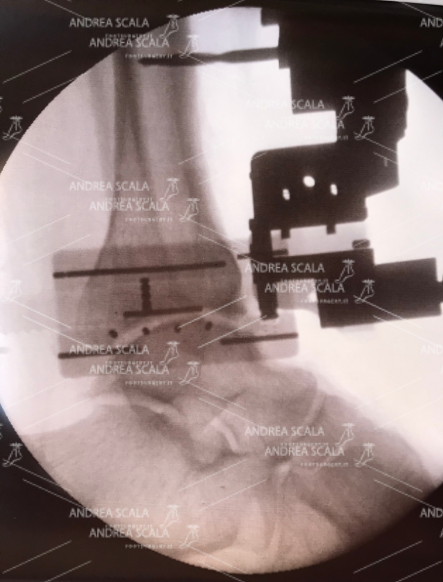 La RX intraoperatoria mostra il sistema della protesi WRIGTH. Si vede la linea di resezione della tibia e lo spazio che verrà occupato dall’inserto in polietilene. I quattro punti che si vedono a livello dell’astragalo rappresentano la resezione dell’osso, che è veramente minima. Vengono fatte resezioni lineari e non curve, perché non c’è alcuna necessità di fare la resezione curva come propone la Zimmer.