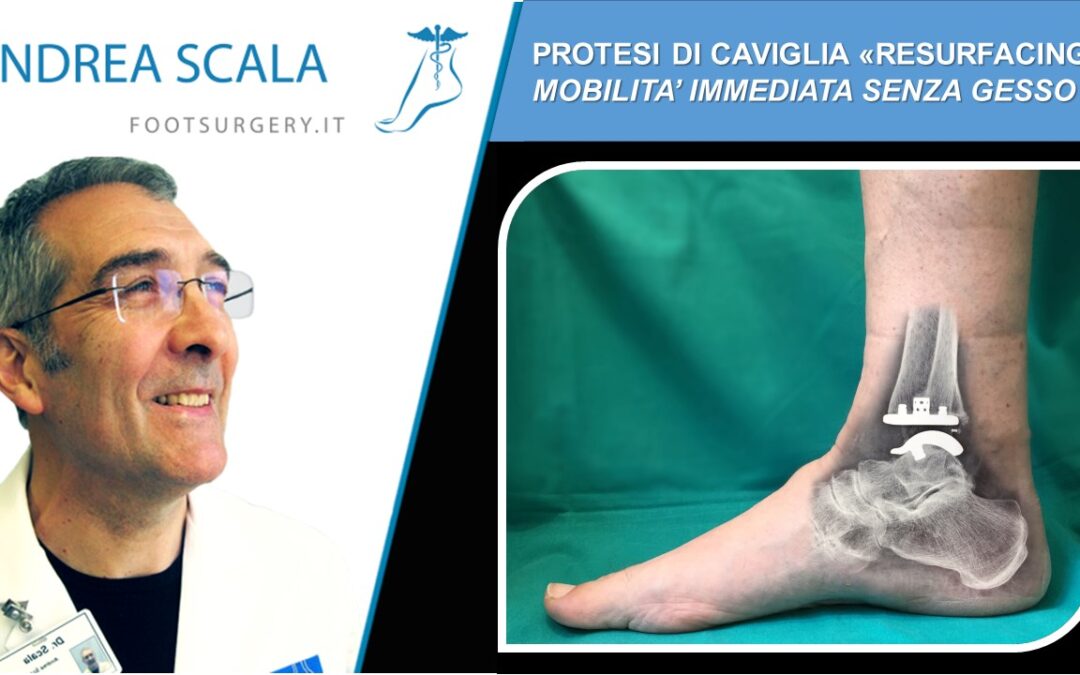 Protesi di caviglia “resurfacing”: mobilità immediata senza gesso