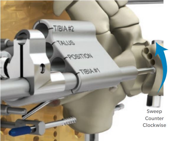 La figura mostra come viene asportato l’osso del paziente dalla tibia, come viene completata la asportazione della superficie della tibia e preparata la superficie della tibia.. Il procedimento è prestabilito ed identico per tutti i pazienti.