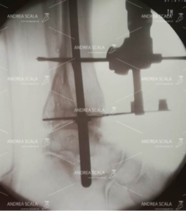 La RXgrafia intra-operatoria mostra la visione laterale del sistema di allineamento della protesi di caviglia, applicato all’esterno all’osso della gamba del paziente. Applicato all’asta di guida si vede  una lunga barra sovrapposta alla tibia. Si vede anche una sottile linea metallica perpendicolare all’asta longitudinale, che aiuta ad impiantare la protesi  perpendicolare all’asse longitudinale della gamba.