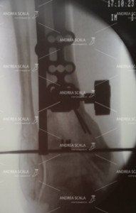 La RXgrafia intra operatoria mostra la visione anteriore dell’apparato di misurazione esterno all’osso della gamba. Il grande apparato deve essere allineato all’asse longitudinale della gamba. La sottile linea metallica assicura che la protesi avrà un andamento parallelo al suolo e che sarà perpendicolare all’asse longitudinale della gamba.