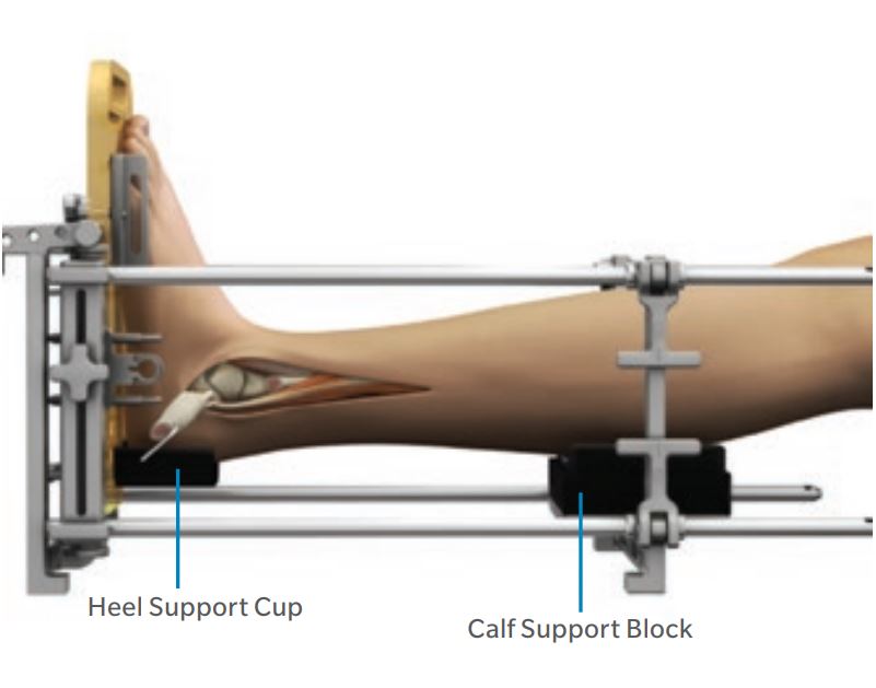 Una impalcatura esterna accoglie la gamba e la caviglia del paziente, che vengono  bloccate da chiodi per fissatore esterno.