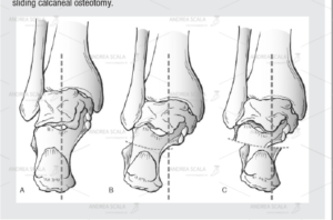 Lo schema illustra la osteotomia di calcagno negli adolescenti. Il piede pronato valgo giovanile viene corretto senza toccare le articolazioni.