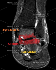 L’articolazione tra astragalo e calcagno in un piede pronato valgo è deviata, ha lavorato male e si è consumata. E’ presente la degenerazione della cartilagine articolare, le ossa si toccano, c’è l’artrosi e c’è molto dolore. Sarebbe stato meglio operare prima.