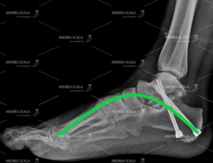 La RXgrafia post-operatoria mostra che l’arco del piede è stato ricostruito. L’articolazione ammalata ha dovuto essere asportata perché causava un grande dolore. Per rifare l’arco sono state necessarie due viti metalliche che tengono insieme il montaggio.