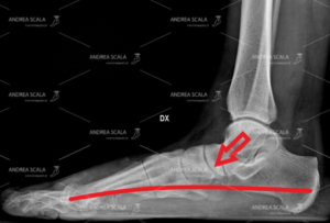 La RXgrafia pre-operatoria del paziente di settanta anni. Si vede il crollo dell’arco del piede. L’astragalo sprofonda verso il suolo perché i legamenti mediali sono sempre stati lassi. Il piede è sato trascurato è sempre stato pronato e instabile. Il dolore è molto forte e il paziento non può più deambulare.