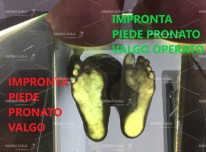 La foto mostra la visione della impronta plantare dello stesso paziente in età adulta con piede pronato grave a confronto con il piede operato.