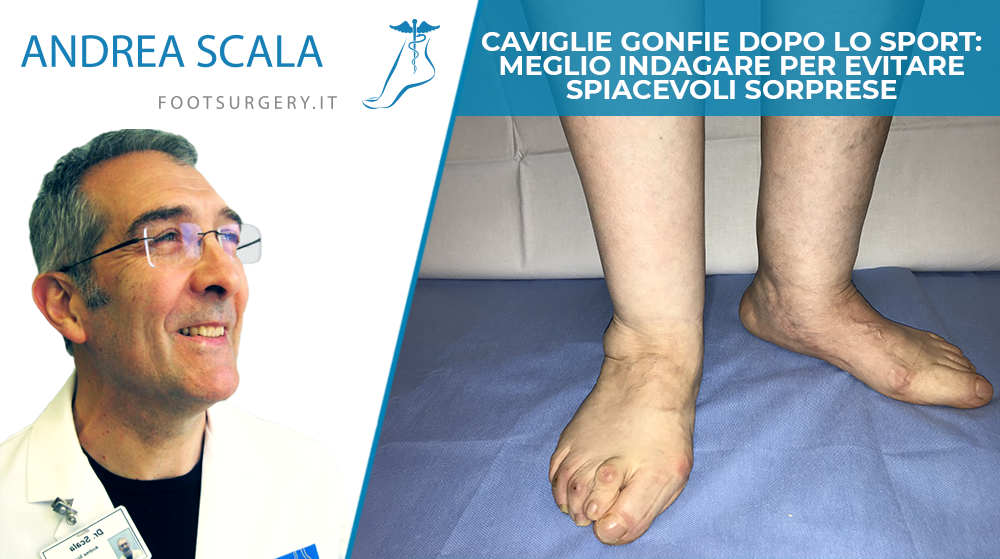 Caviglie gonfie dopo lo sport: meglio indagare per evitare spiacevoli sorprese