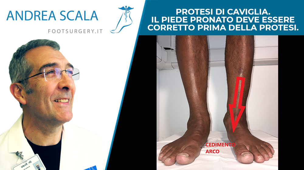 PROTESI DI CAVIGLIA. IL PIEDE PRONATO DEVE ESSERE CORRETTO PRIMA DELLA PROTESI.