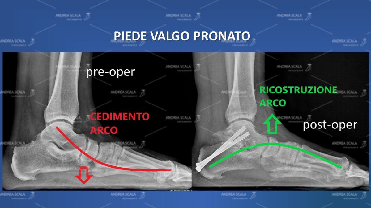 piede-valgo-pronato-correzione 4.jpeg