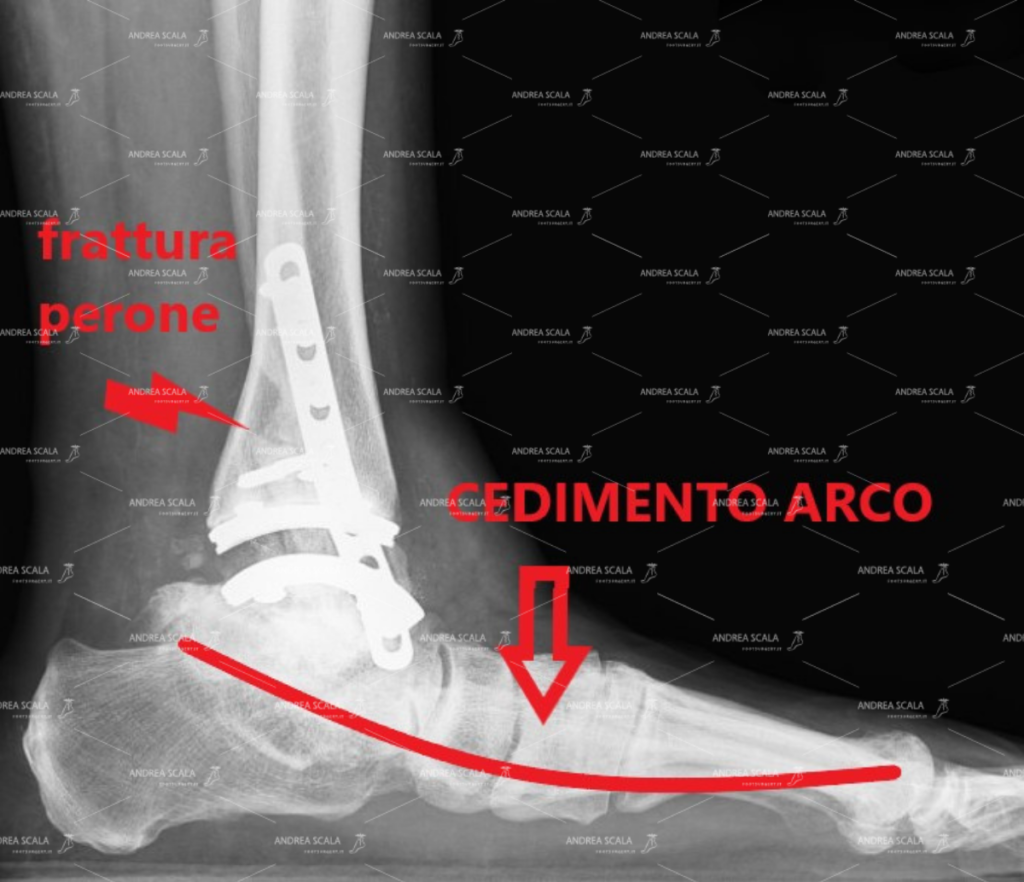 protesi-caviglia-piede-pronato 2.jpeg