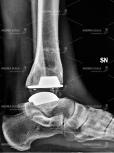 protesi-caviglia-supramalleolar