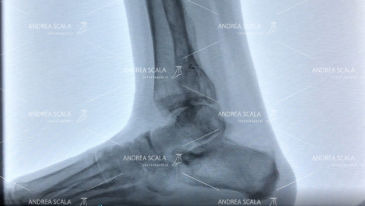 ankle-arthrosis-post-trauma-5.jpg