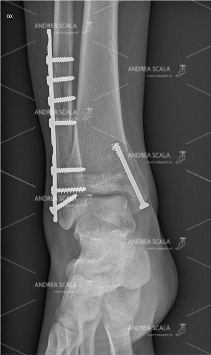 ankle-fracture-RX-anterior-2