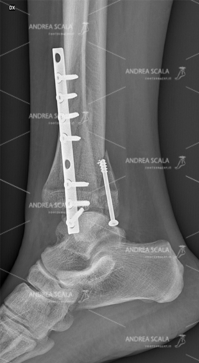 ankle-fracture-RX-lateral-4