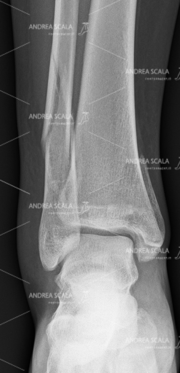 ankle-fracture-anterior-1.jpg