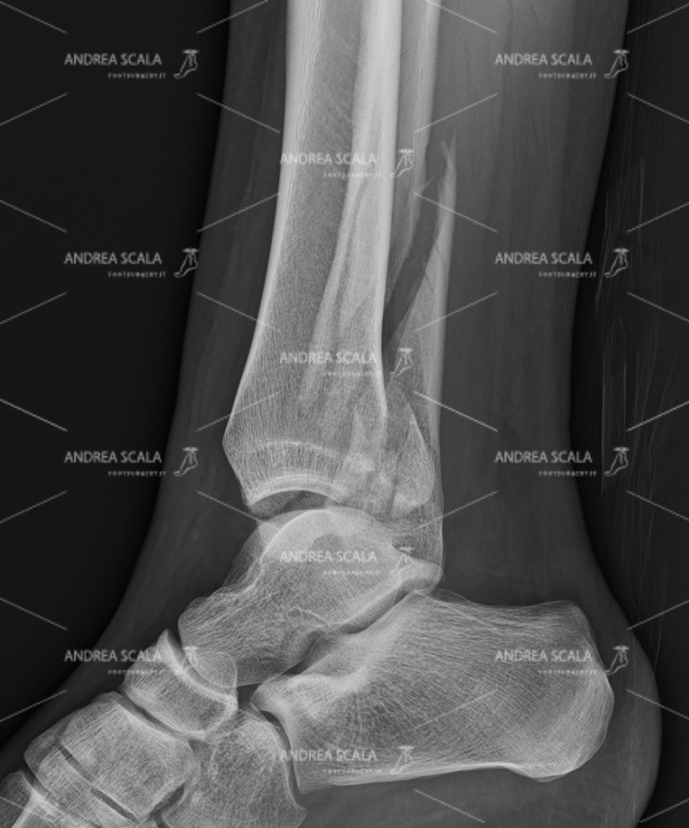ankle-fracture-lateral-3.jpg