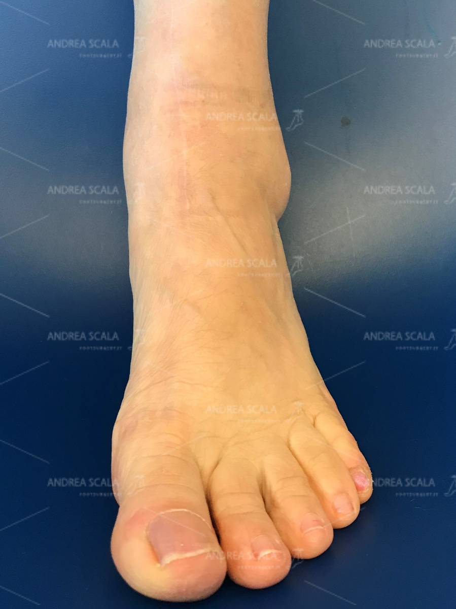 ankle-replacement-anterior-approach-0.jpg