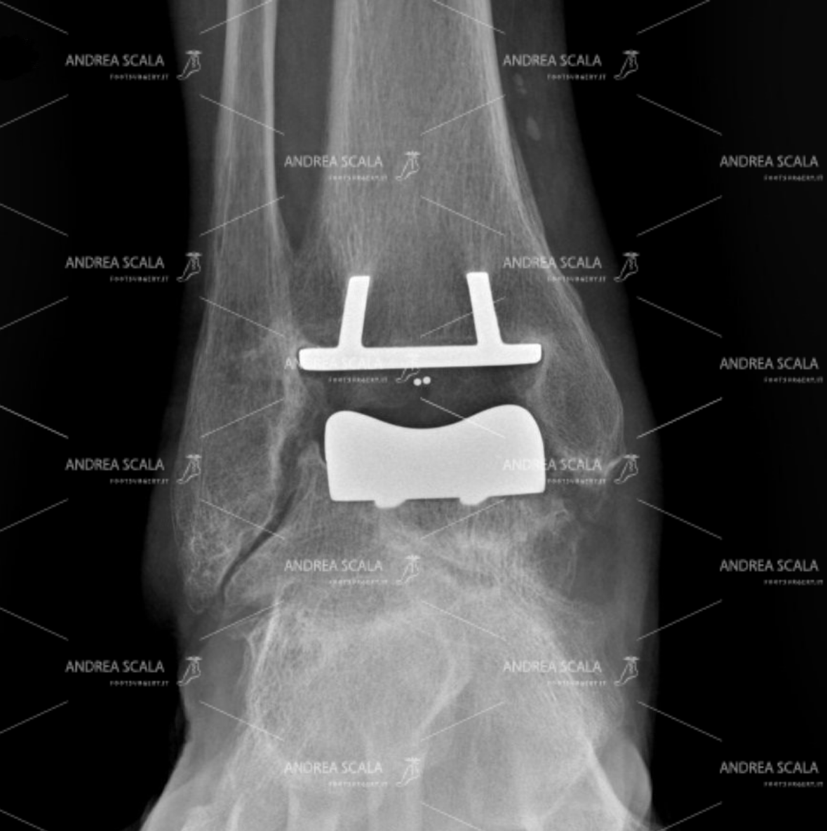 ankle-replacement-anterior-approach- 1.jpeg