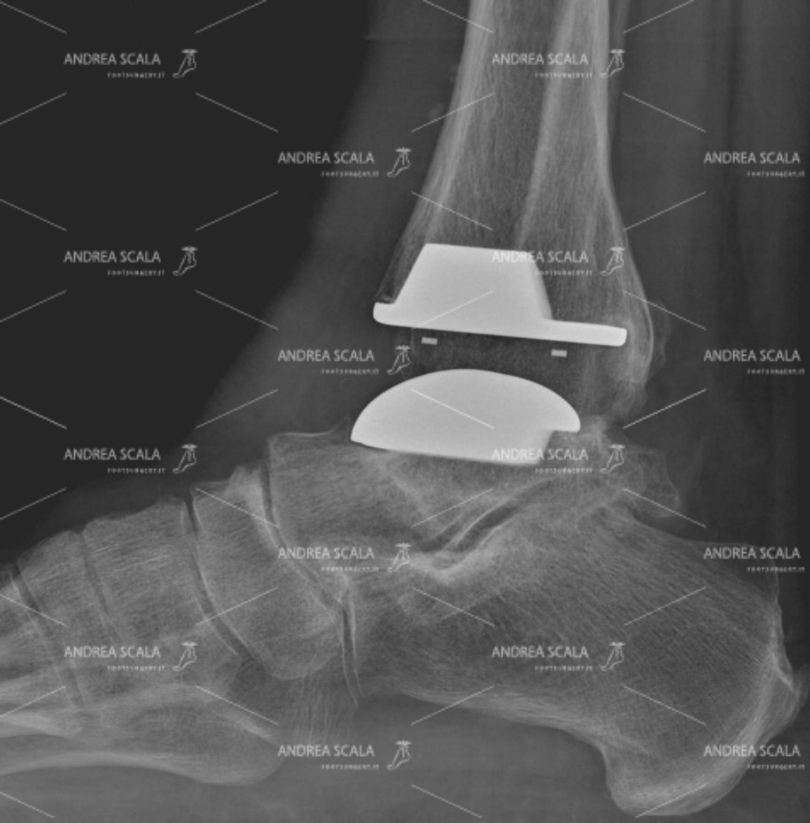 ankle replacement-anterior-approach- 2.jpeg