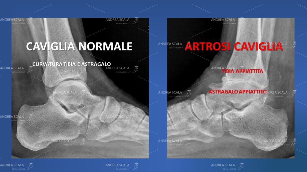 La figura mostra il confronto tra la caviglia normale e la caviglia artrosica. Nella normalità c’è una naturale curvatura della tibia e dell’astragalo. Nella artrosi la tibia e l’astragalo presentano superfici appiattite.