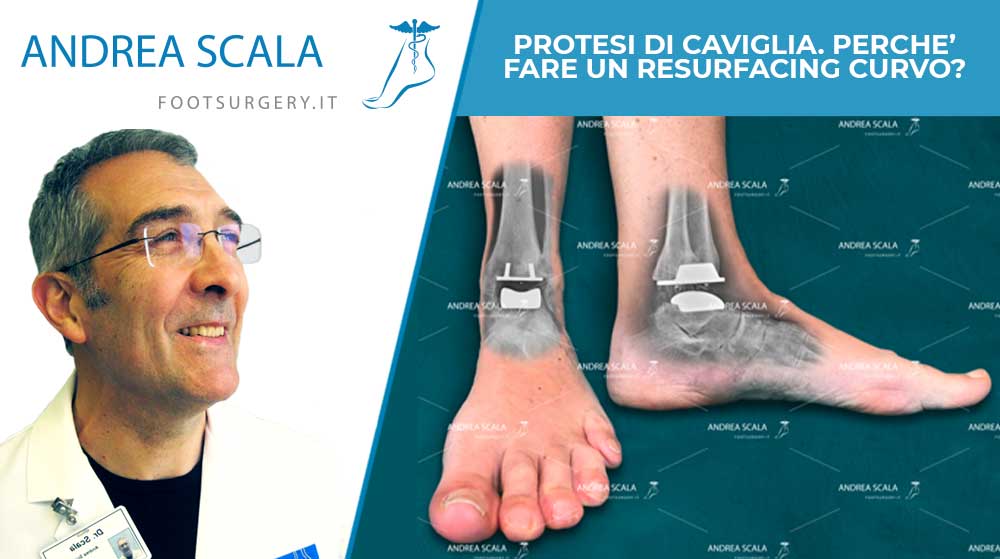 PROTESI DI CAVIGLIA. PERCHE’ FARE UN RESURFACING CURVO? MOLTO SPESSO NON SERVE PERCHE’ NELLA ARTROSI LA SUPERFICIE ARTICOLARE E’ PIATTA.