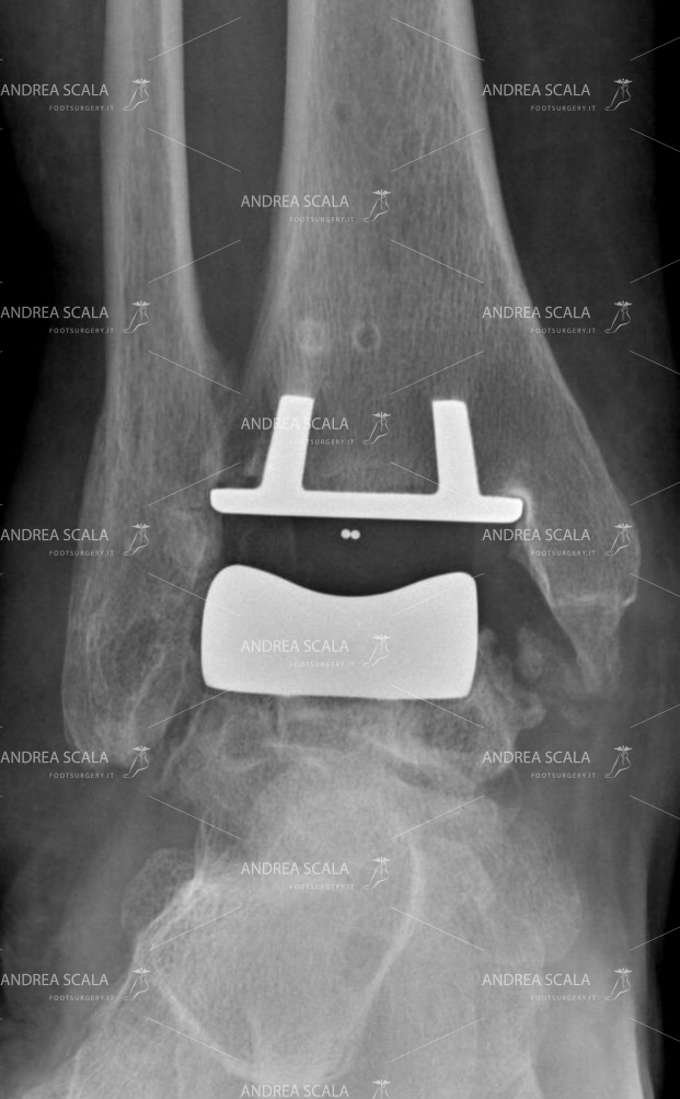 La radiografia anteriore mostra la protesi impiantata dopo la minima resezione lineare. Lo spazio articolare viene mantenuto dall’inserto in polietilene.