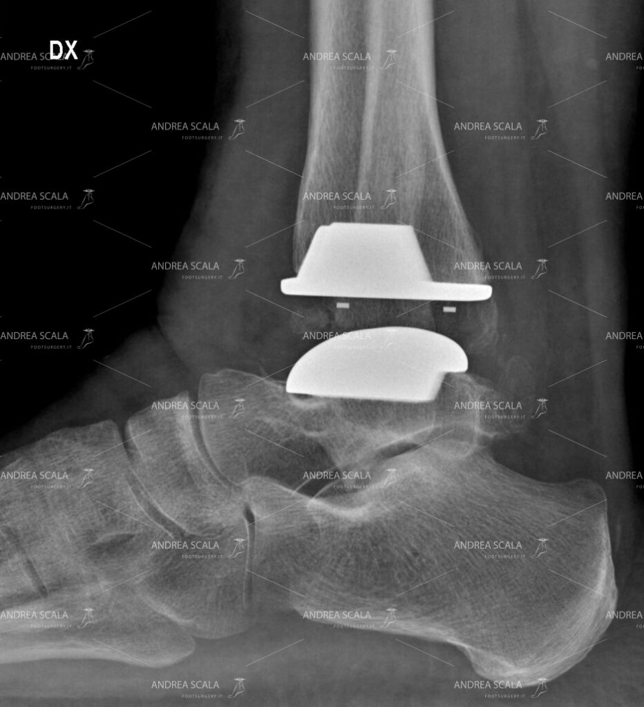 La radiografia laterale mostra la protesi impiantata dopo la minima resezione lineare. E’ la superficie curva dell’impianto astragalico che determina il movimento della caviglia. Non è la resezione curva delle ossa che determina il movimento della caviglia.