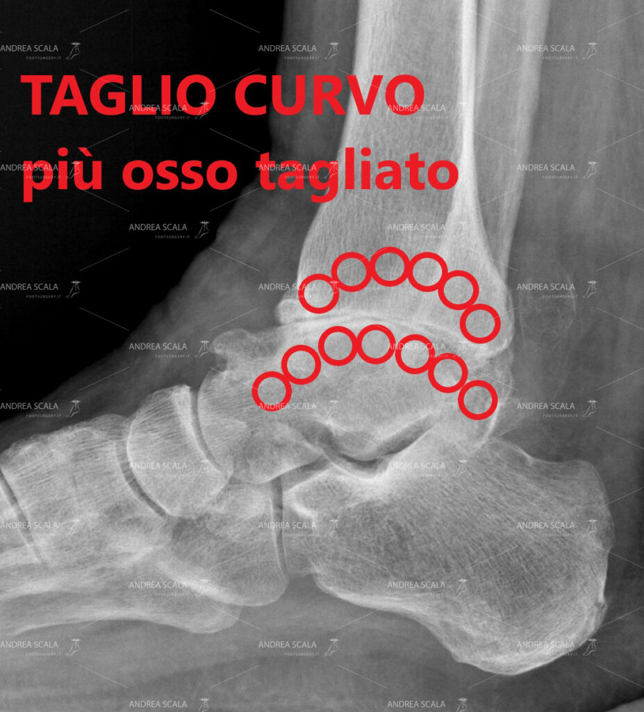 Nei casi di appiattimento delle superfici articolari quando si cerca di realizzare la resezione curva si corre il rischio di asportare più osso del dovuto e di invadere l’articolazione sottostante alla caviglia