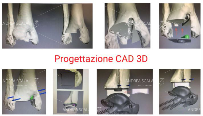 Progettazione protesi di camviglia 3d