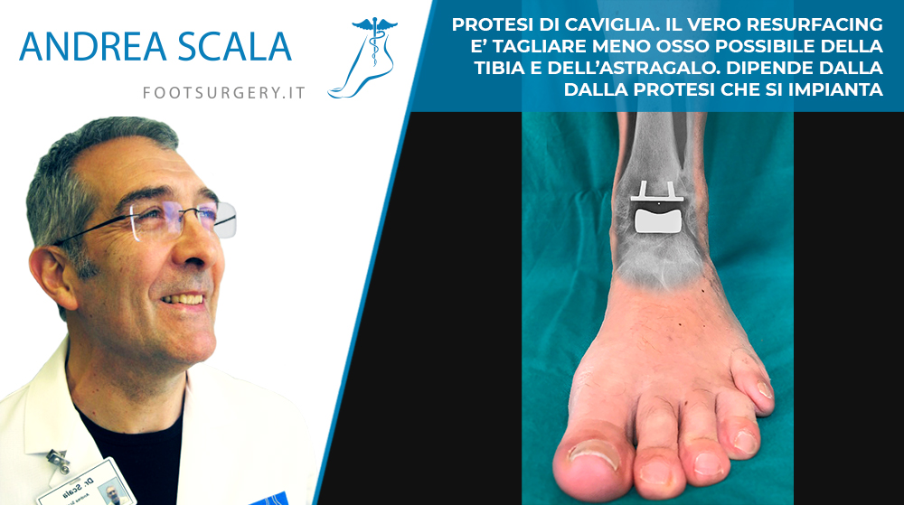 PROTESI DI CAVIGLIA. IL VERO RESURFACING È TAGLIARE MENO OSSO POSSIBILE DELLA TIBIA E DELL’ASTRAGALO. DIPENDE DALLA PROTESI CHE SI IMPIANTA