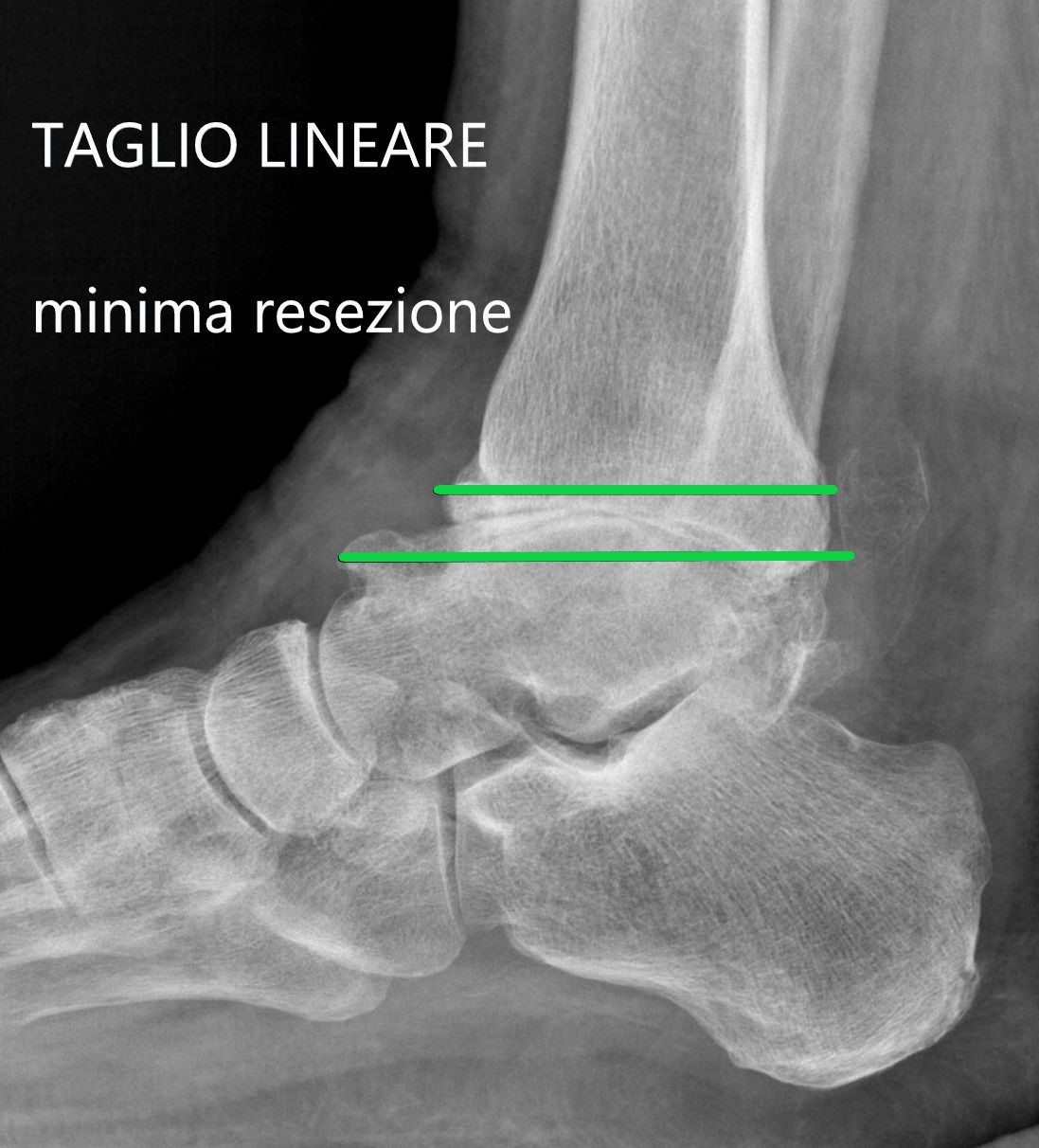 LA TIBIA E L’ASTRAGALO APPAIONO MOLTO APPIATTITI. LA RESEZIONE LINEARE RISPETTA LA SITUAZIONE DETERMINATA DALLA MALATTIA E ASPORTA POCHI MILLIMETRI DI OSSO DA ENTRAMBE LE OSSA. QUESTO È IL VERO RISPARMIO DELL’OSSO DEL PAZIENTE.