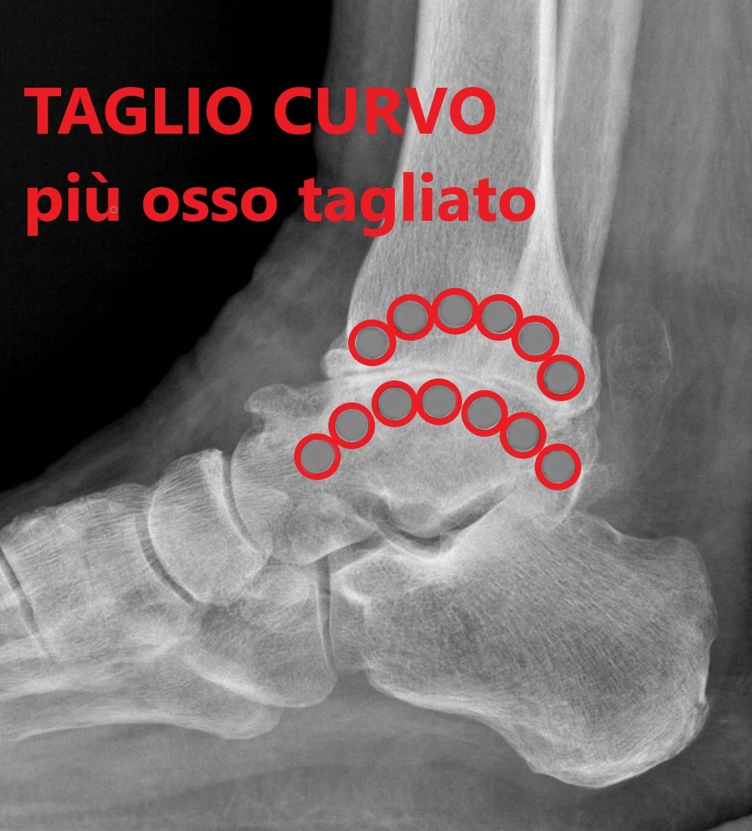 LA VIA D’ACCESSO LATERALE PREVEDE UNA FASE DI PERFORAZIONI DELLA TIBIA E DELL’ASTRAGALO PER FARE LA RESEZIONE CURVA