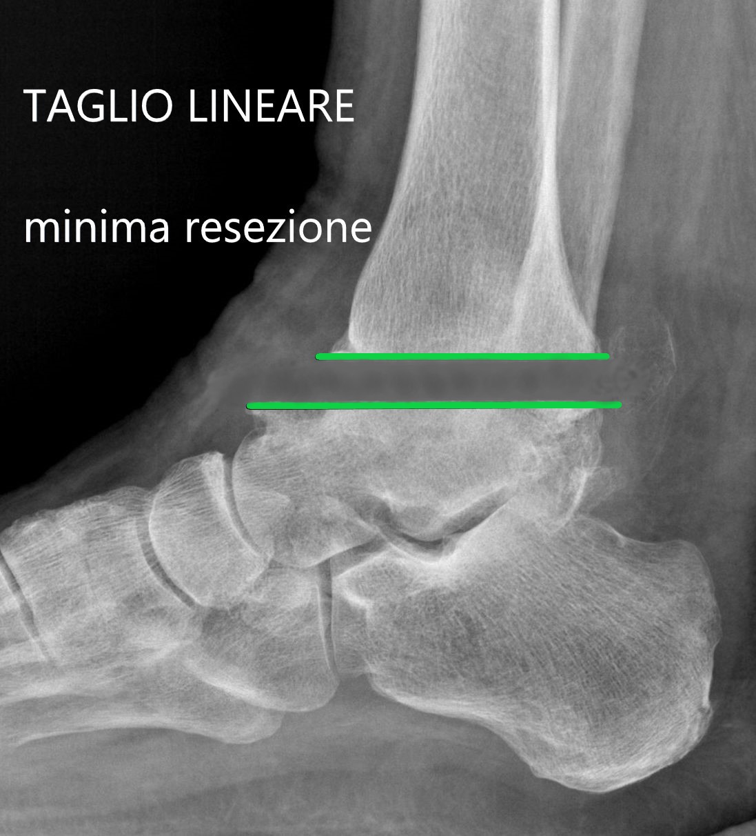 LA RESEZIONE LINEARE RISPETTA L’APPIATTIMENTO DI TIBIA E ASTRAGALO E ASPORTA POCHI MILLIMETRI DI OSSO DA ENTRAMBE LE OSSA. QUESTO È IL VERO RISPARMIO DELL’OSSO DEL PAZIENTE. SULLA TIBIA È SUFFICIENTE APPOGGIARE UNA COMPONENTE DI SOLI 3 MILLIMETRI.