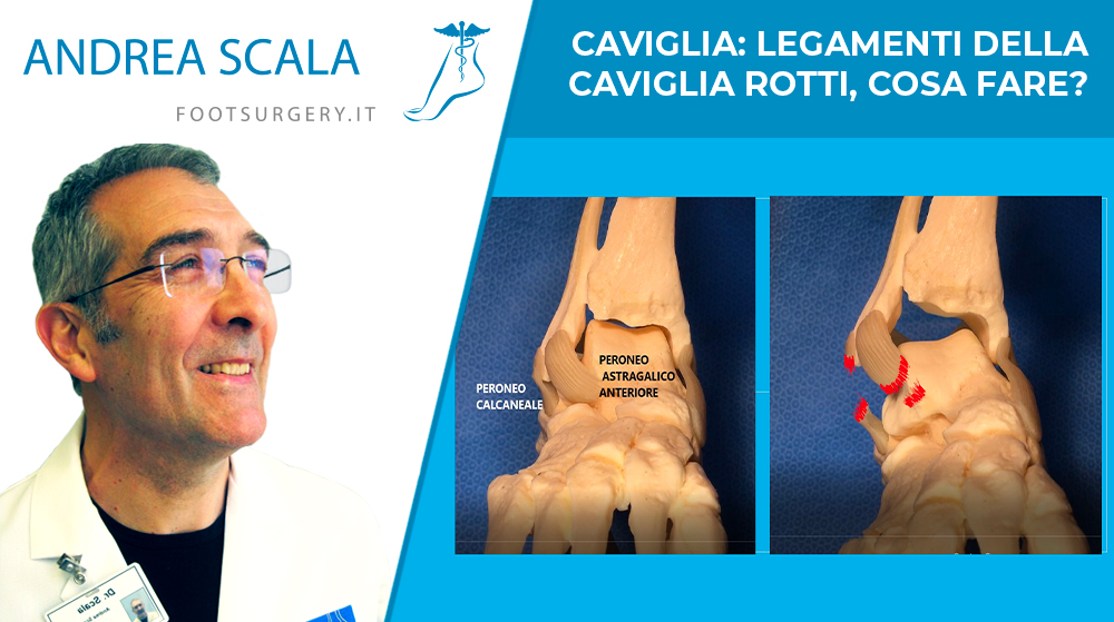 Caviglia: legamenti della caviglia rotti, cosa fare?