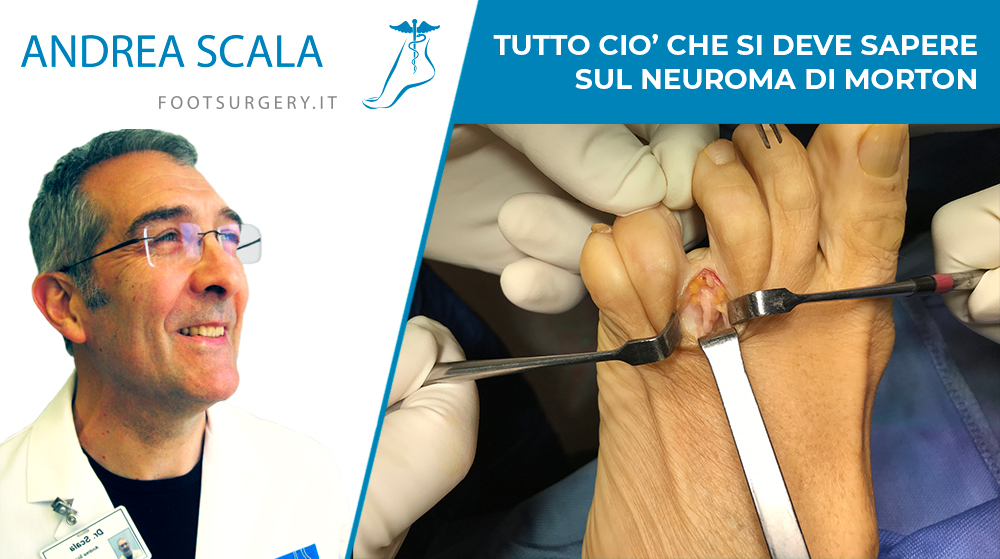 TUTTO CIO’ CHE SI DEVE SAPERE SUL NEUROMA DI MORTON