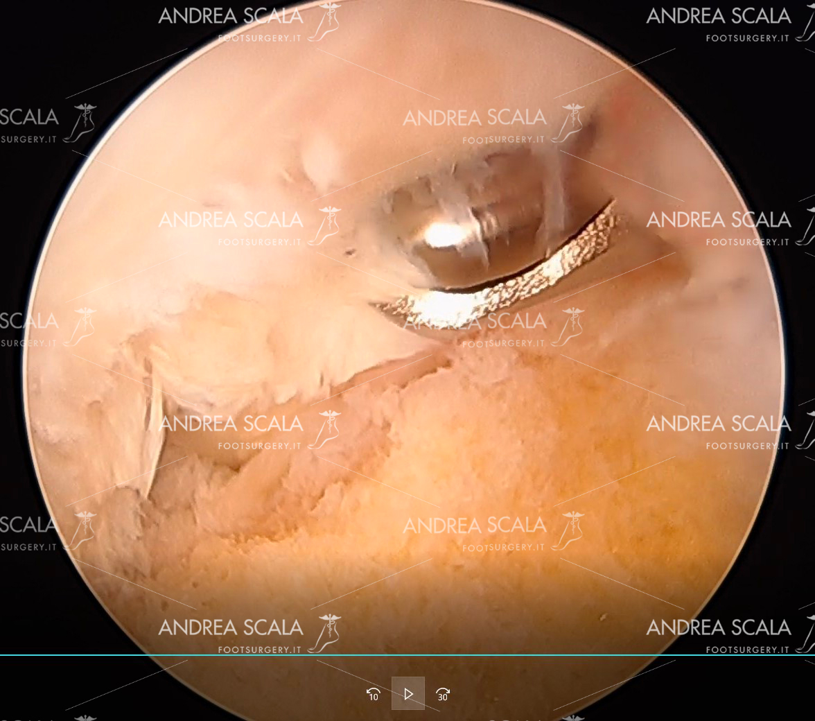 Fase di intervento in atroscopia: fresa pulisce il tendine