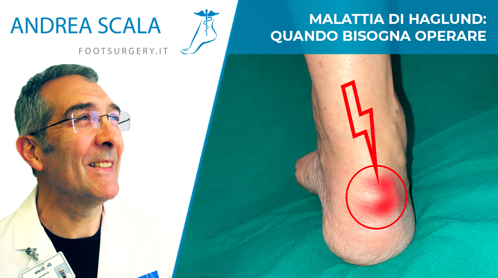 Malattia di Haglund: quando bisogna operare