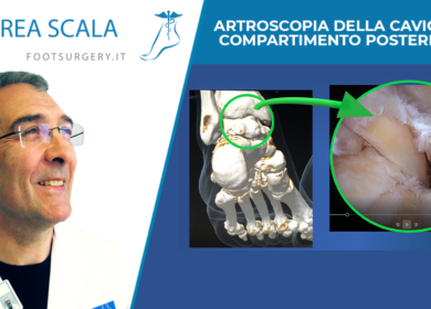 ARTROSCOPIA DELLA CAVIGLIA: COMPARTIMENTO POSTERIORE.