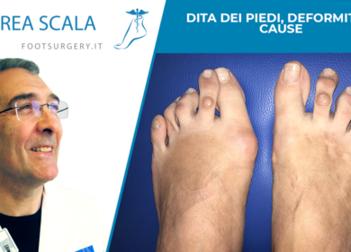 Dita dei piedi, deformità e cause