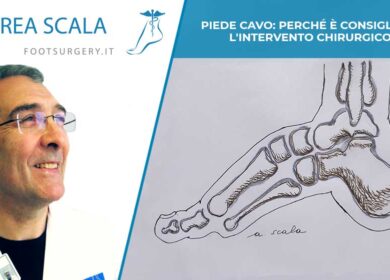 Piede cavo: perché è consigliato l’intervento chirurgico